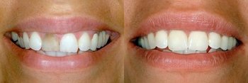 Smile Gallery - Eco Dental, Homer Glen Dentist