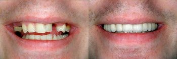 Smile Gallery - Eco Dental, Homer Glen Dentist