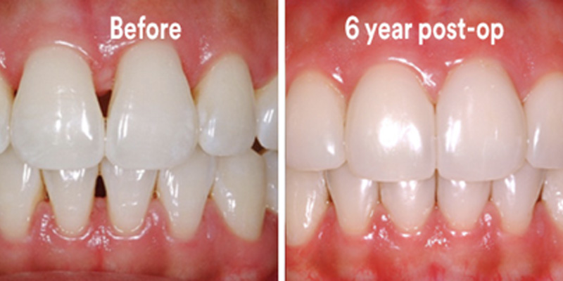 BioClear Diastema Closure and Black Triangle Closure  - Eco Dental, Homer Glen Dentist