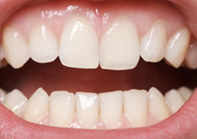 Cosmetic Bonding  - Eco Dental, Homer Glen Dentist
