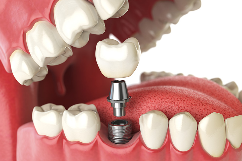 Dental Implants - Eco Dental, Homer Glen Dentist