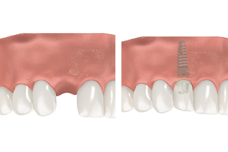 Dental Implants - Eco Dental, Homer Glen Dentist