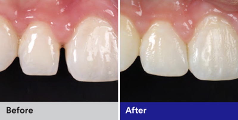BioClear Diastema Closure and Black Triangle Closure  - Eco Dental, Homer Glen Dentist