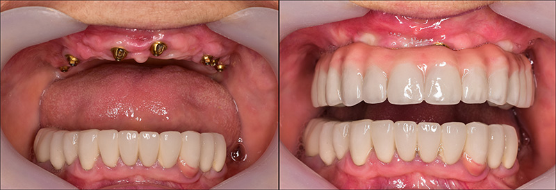 Implant Overdentures and Fixed All-On-X Treatment  - Eco Dental, Homer Glen Dentist