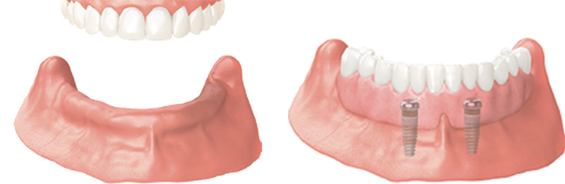Implant Overdentures and Fixed All-On-X Treatment  - Eco Dental, Homer Glen Dentist