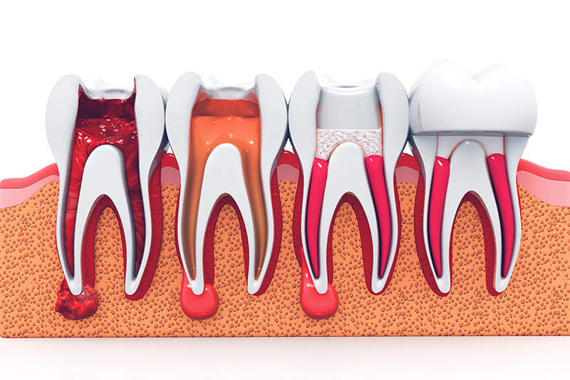 Terapia de Endodoncia  - Eco Dental, Homer Glen Dentist