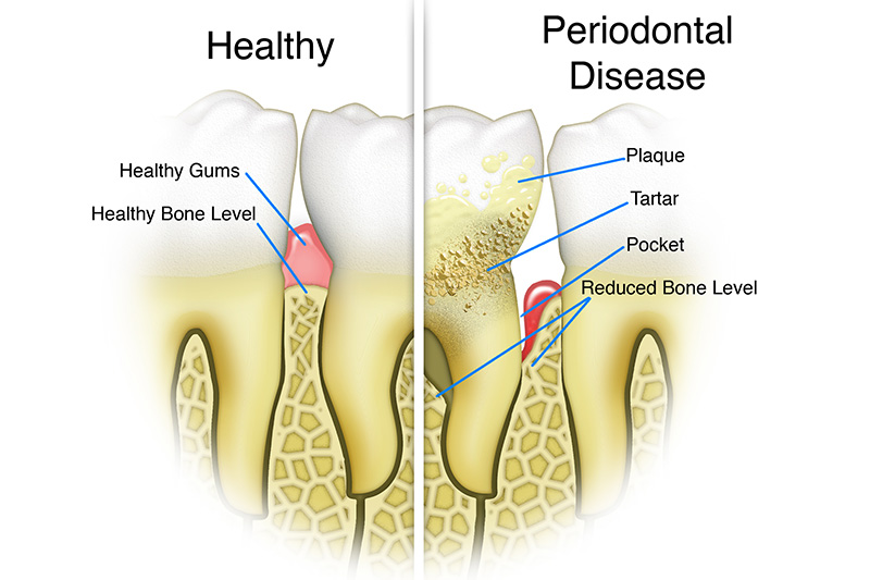 Scaling & Root Planings (Deep Cleanings)  - Eco Dental, Homer Glen Dentist