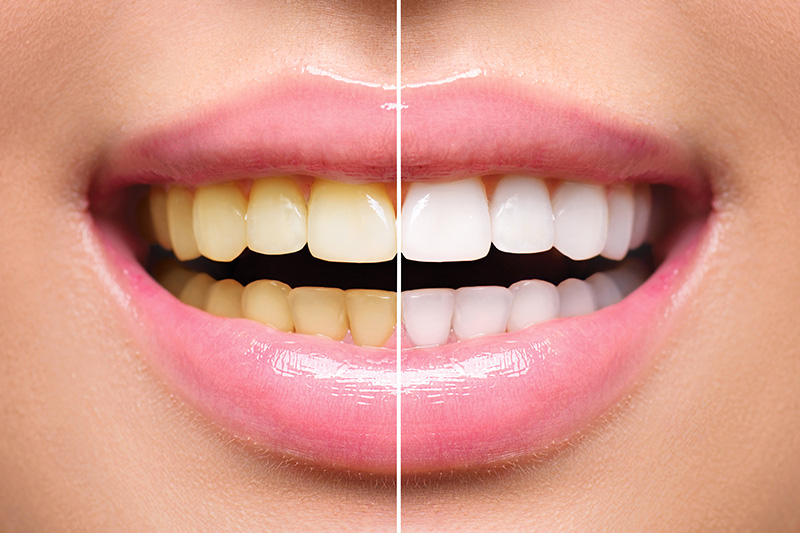 Teeth Whitening - Eco Dental, Homer Glen Dentist