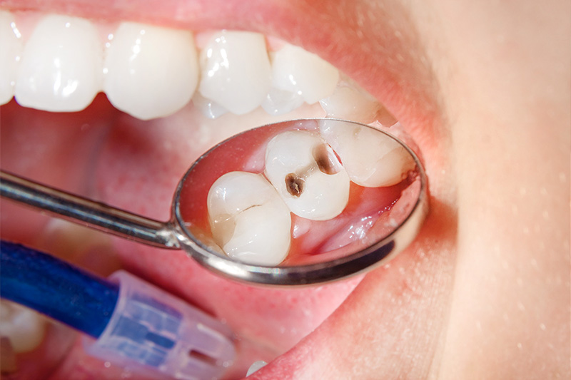 Tooth Colored Composite Fillings  - Eco Dental, Homer Glen Dentist