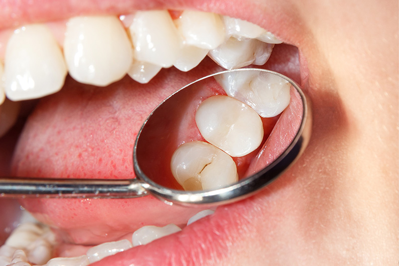 Tooth Colored Composite Fillings  - Eco Dental, Homer Glen Dentist