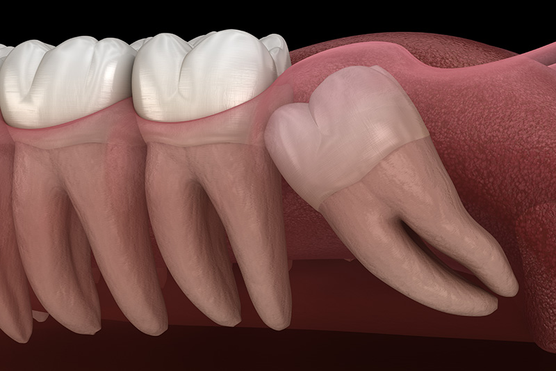 Wisdom Teeth Extractions (with Sedation)  - Eco Dental, Homer Glen Dentist